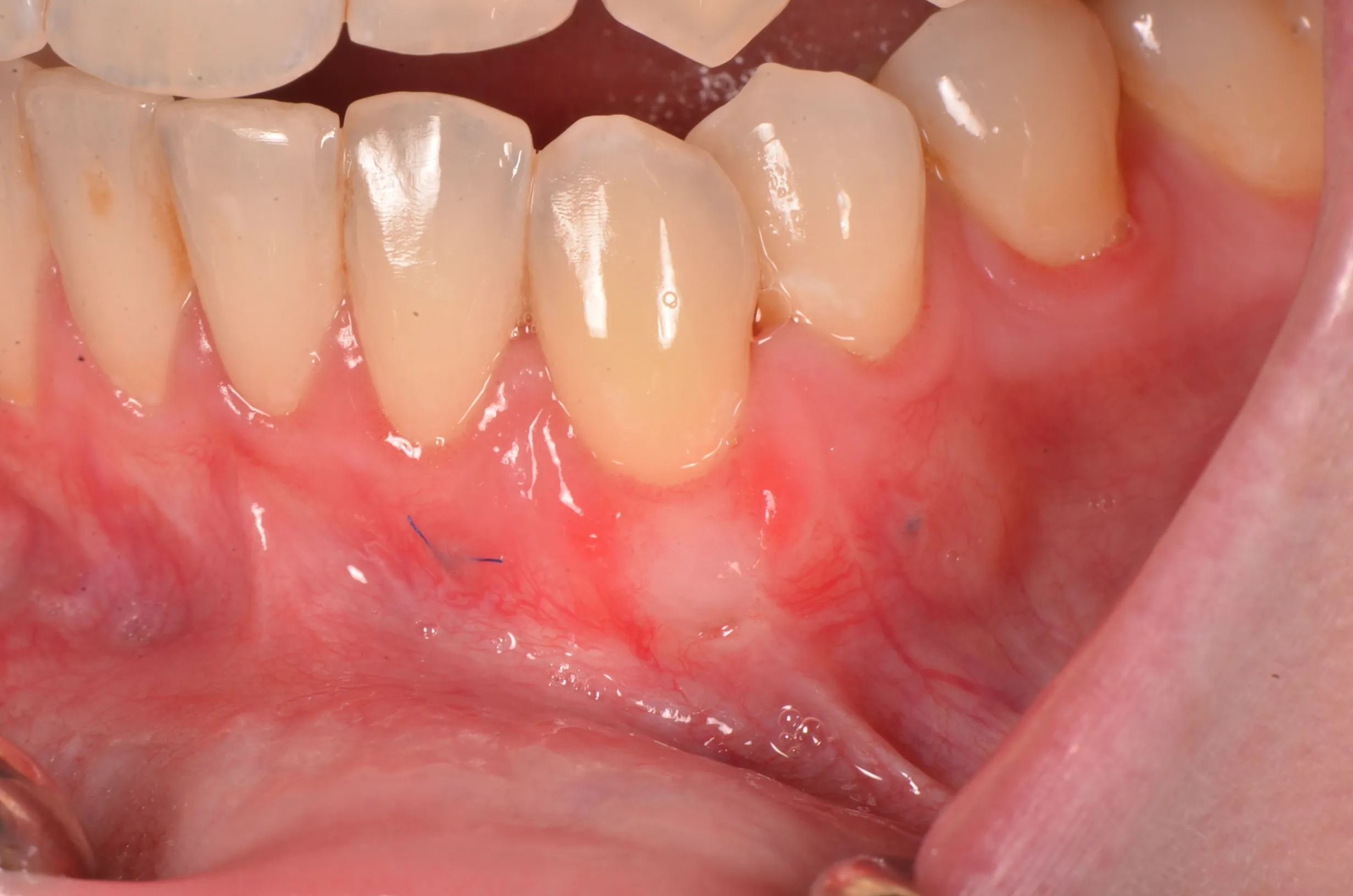 Gum grafting (CTG) outcome restoring receding gums in Davenport, FL