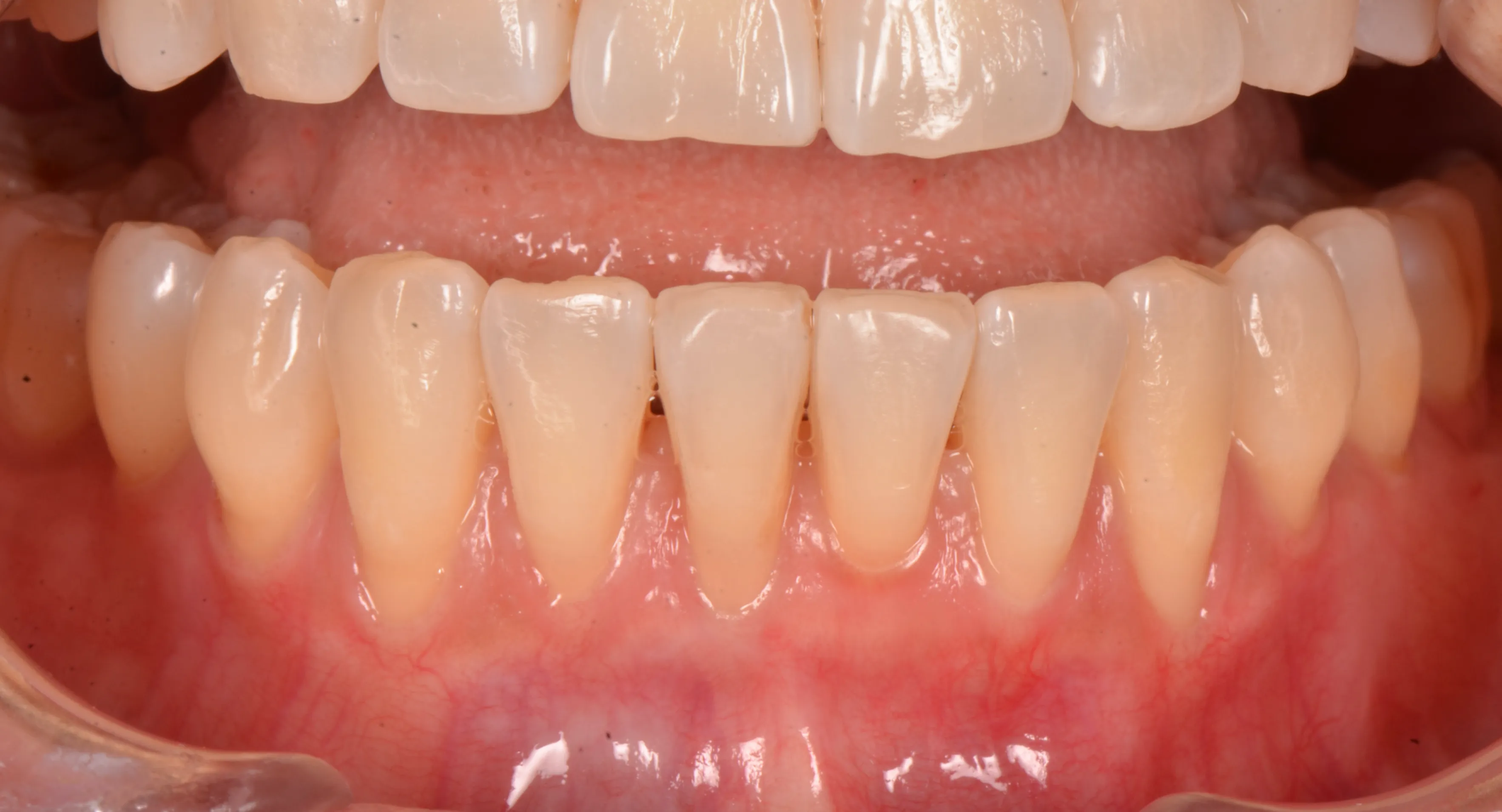 Connective tissue graft result restoring a natural gum line at AVA Dental