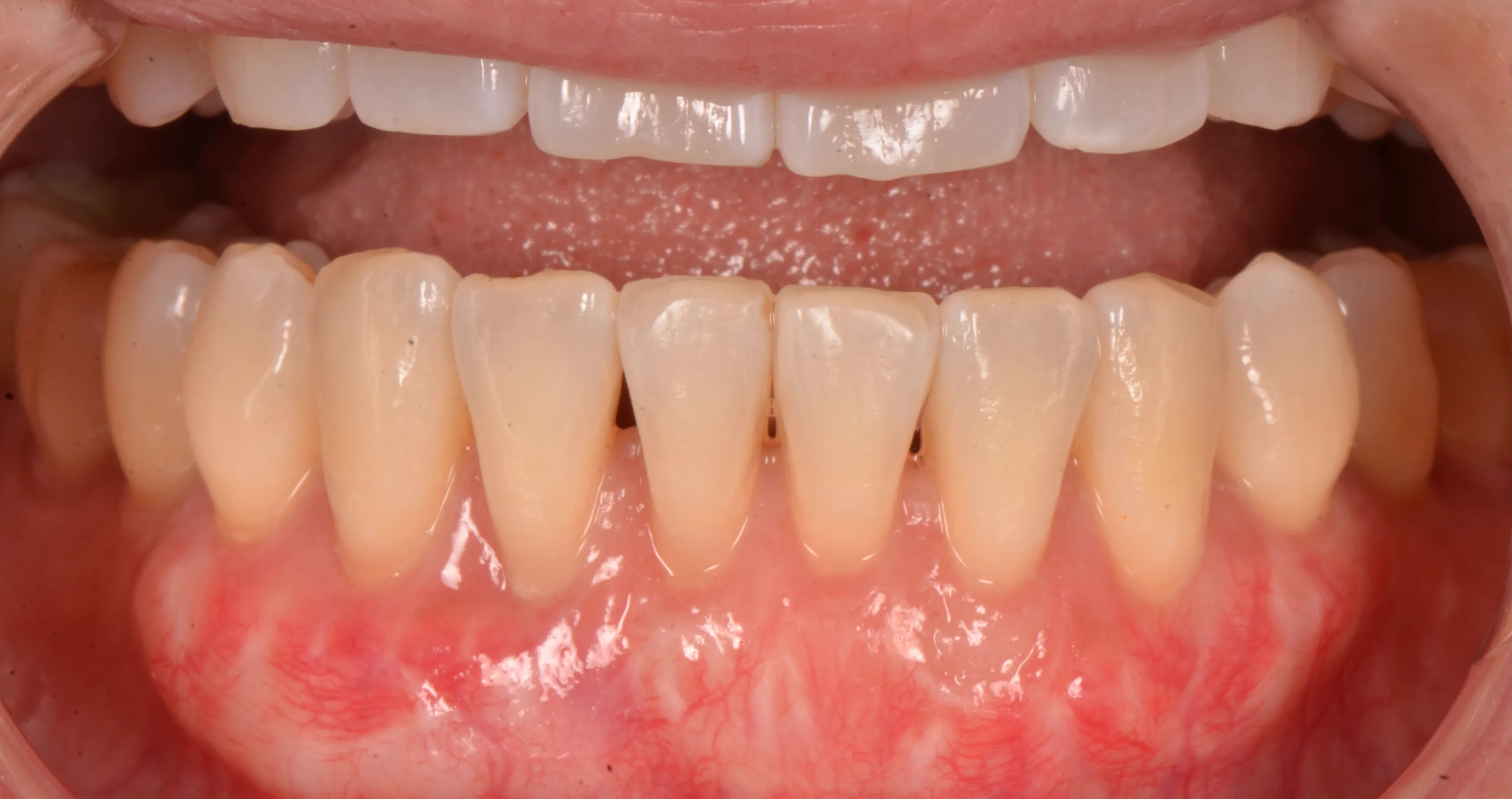  Soft tissue graft (CTG) outcome by Dr. Rafik Dib