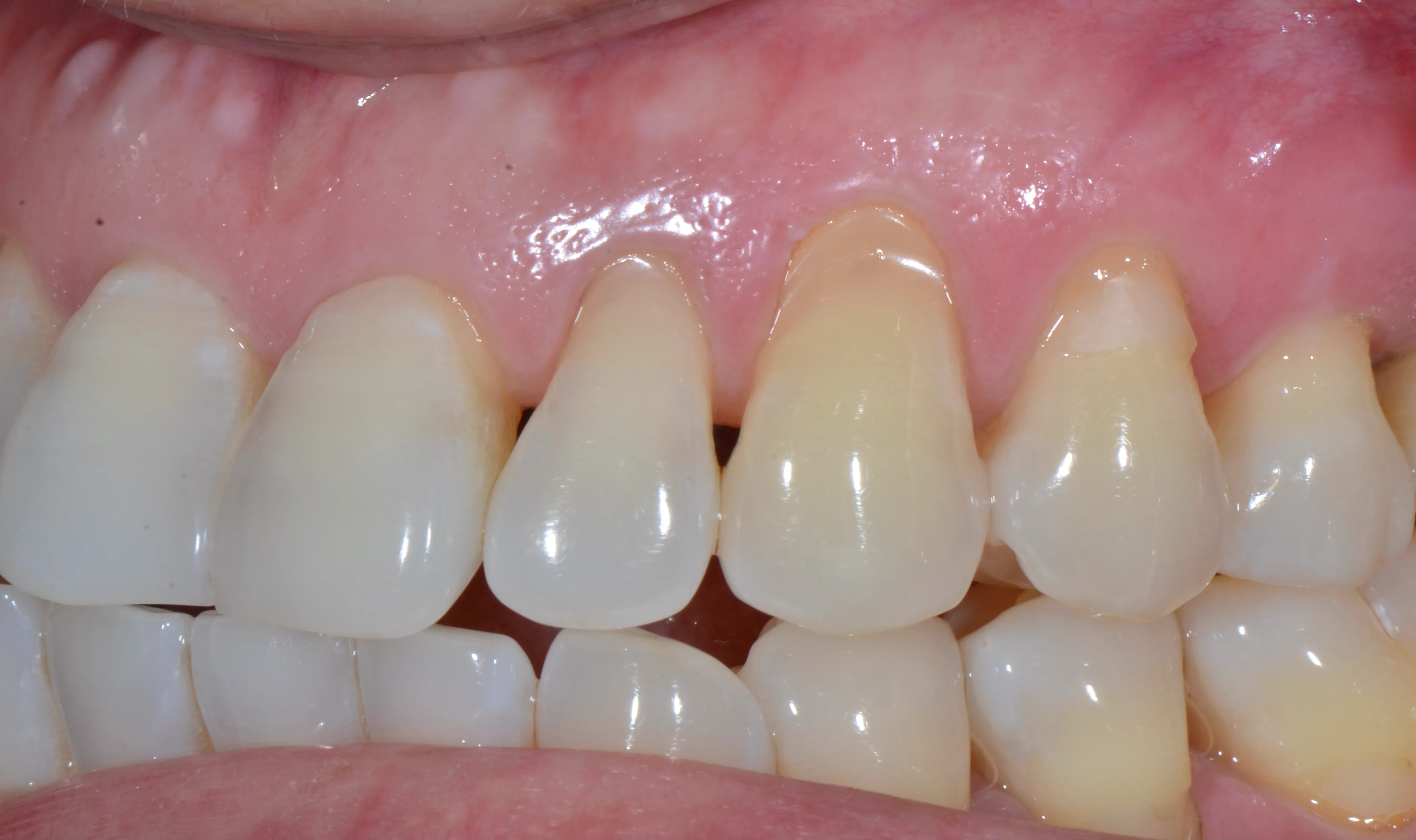 Connective tissue graft result improving gum coverage and health