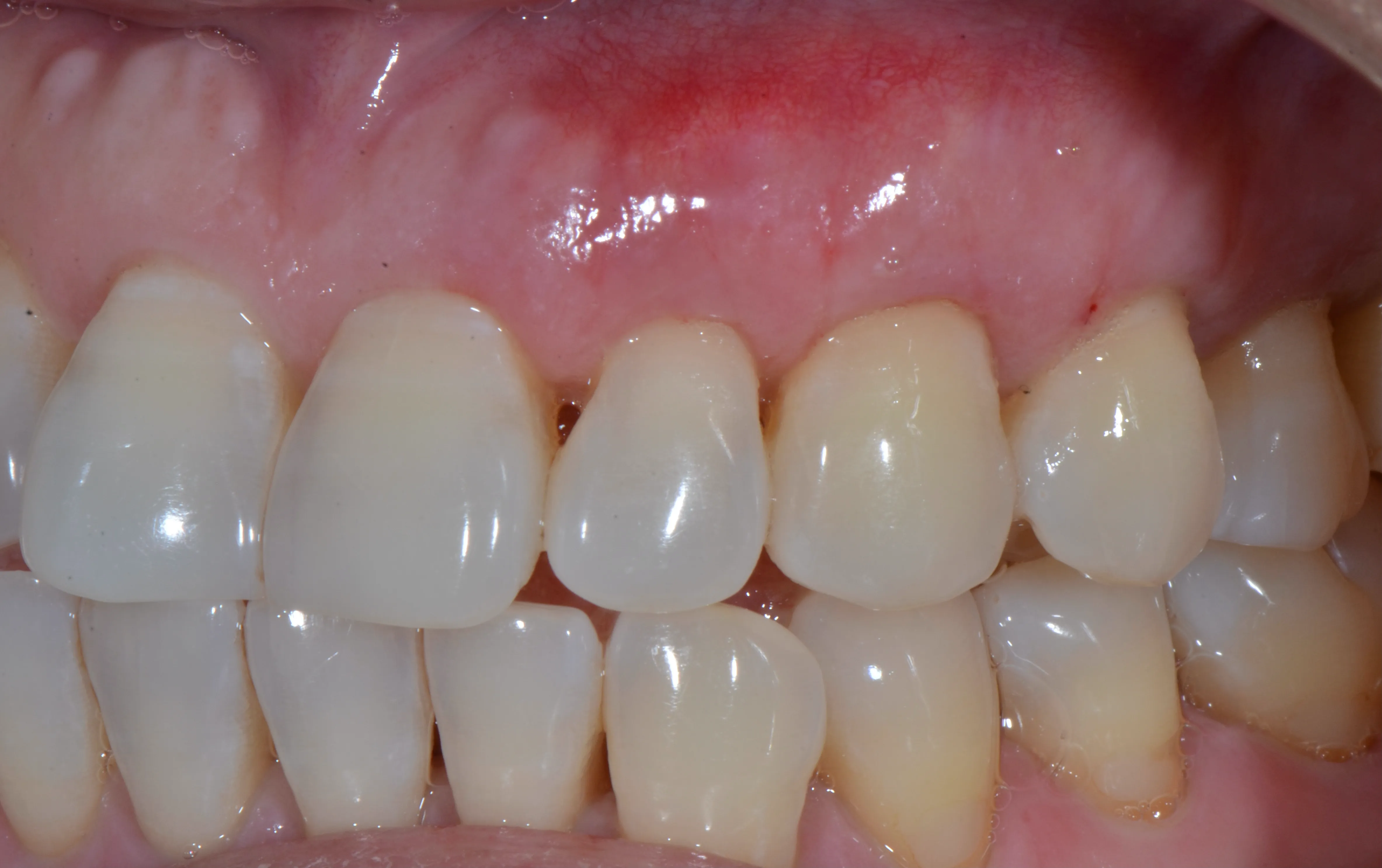 Gum recession treatment result following a connective tissue graft