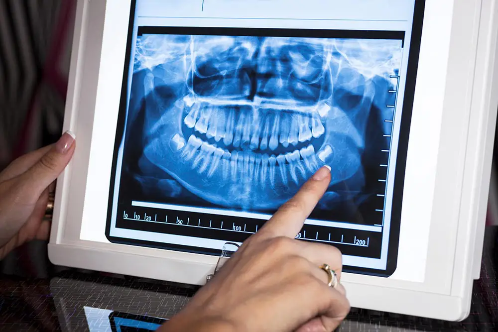 Close-up of a hand pointing at a dental X-ray image showing a full set of teeth and jawbones on a lightbox.