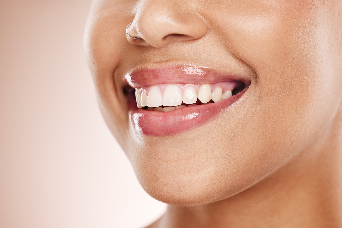 How White Fillings Stay Invisible When I Laugh or Talk