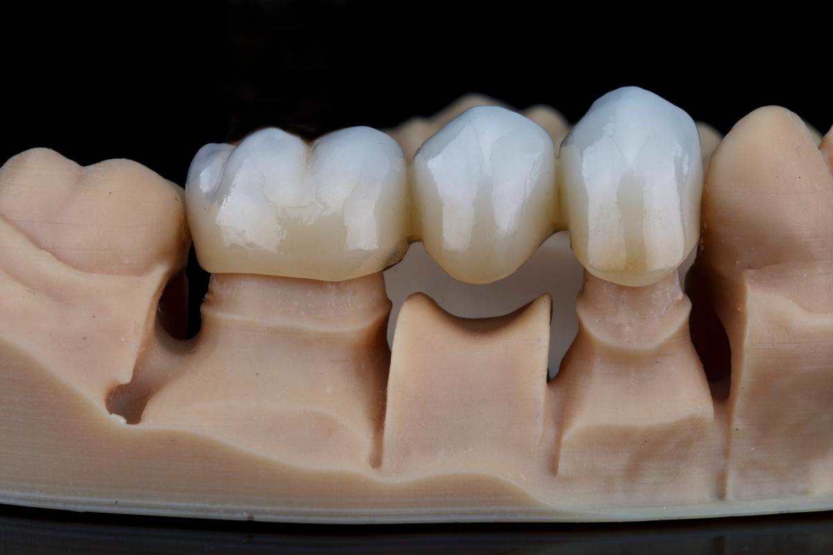 How to Clean and Care for a Dental Bridge: Dr. Bernitsky’s Checklist