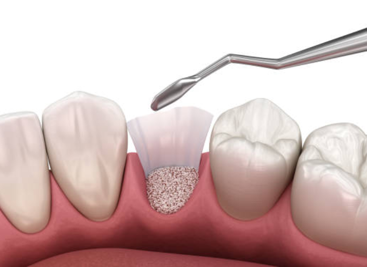 Can Dental Implants Be Done Without Bone Grafting?