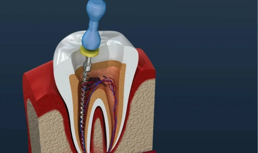Can Root Canal Improve Your Smile Like Cosmetic Dentistry?