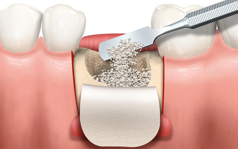 How Long Does It Take To Recover From Bone Grafting?