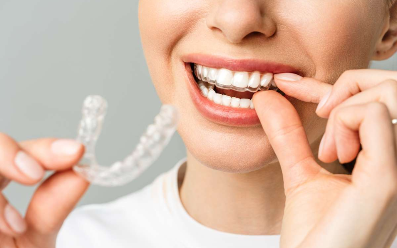 Clear Aligners for Adults: Why It’s Never Too Late to Improve Your Smile?