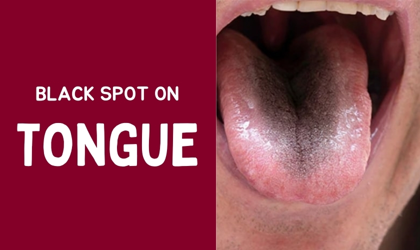 Which Vitamin Deficiency Causes Black Spots On The Tongue?