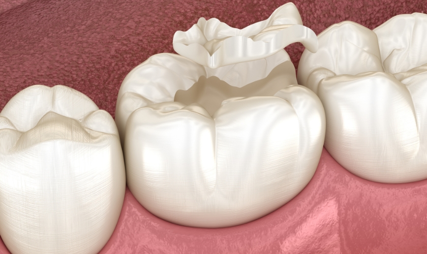 How Long Do Dental Sealants Last?
