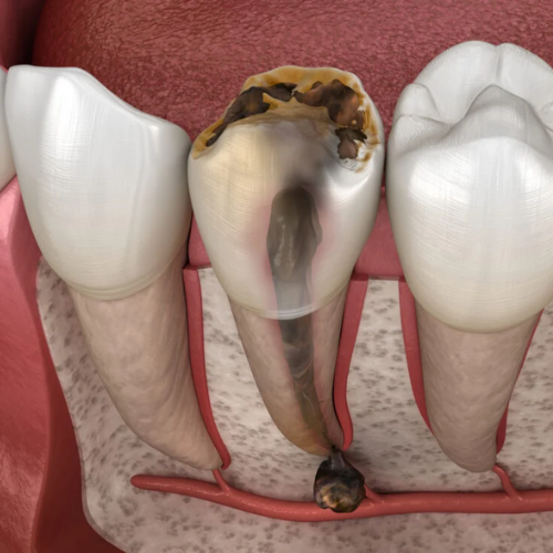 Severe Tooth Damage - Dental Emergency Sign