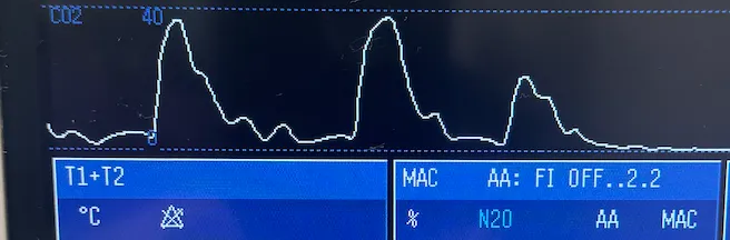 The author’s photograph of a respiratory waveform display