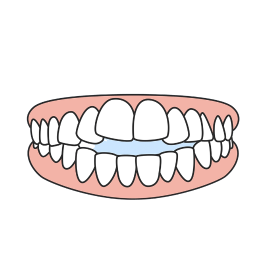 Open Bite