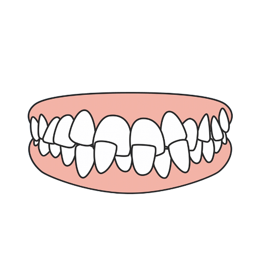 Crossbite
