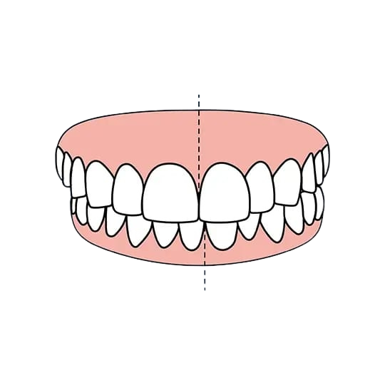 Midline Deviation