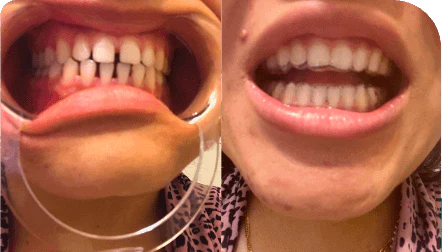 Overbite