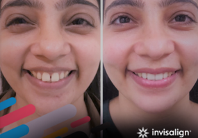 Invisalign result 2