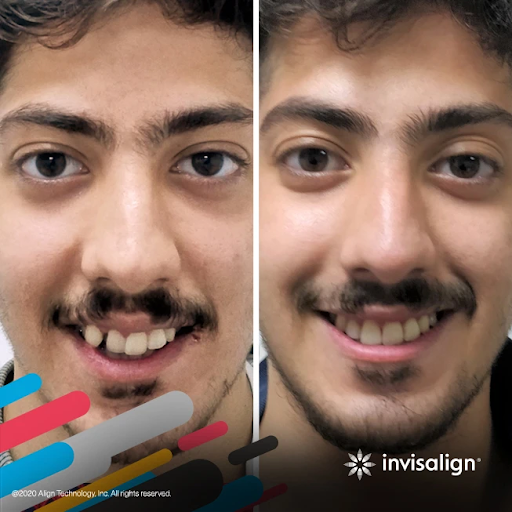 Invisalign result 3