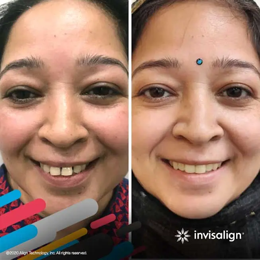 Invisalign result 4