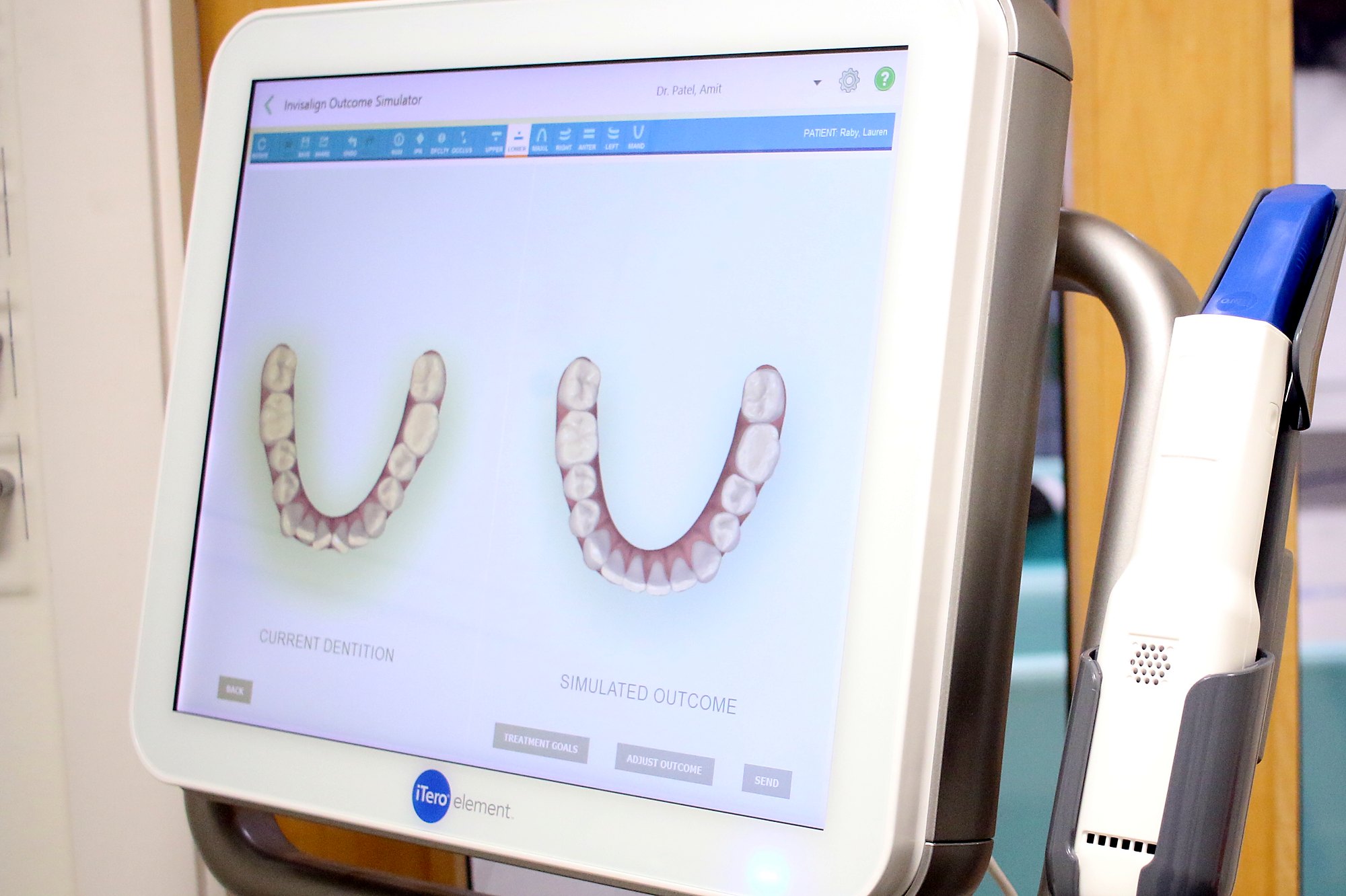 The iTero scanner with a scan on screen