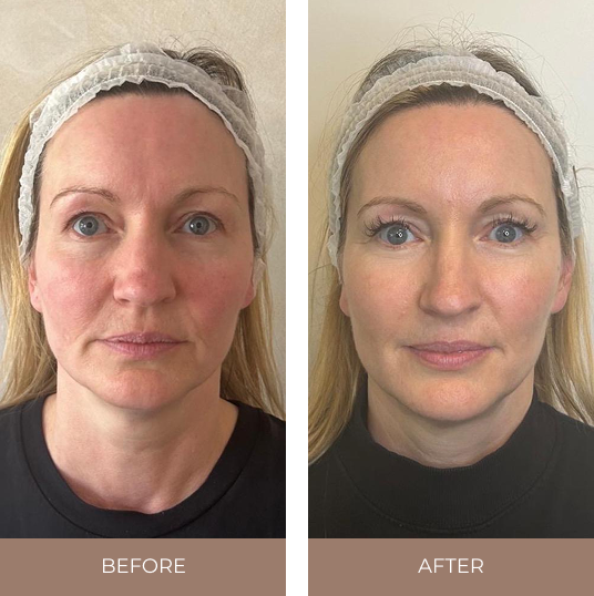 Before and after comparison showing facial appearance