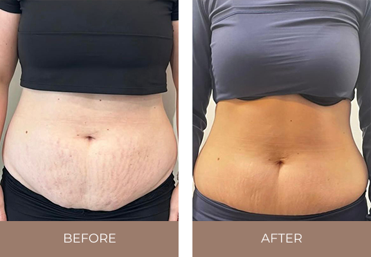 Before and after comparison of the abdominal area following treatment