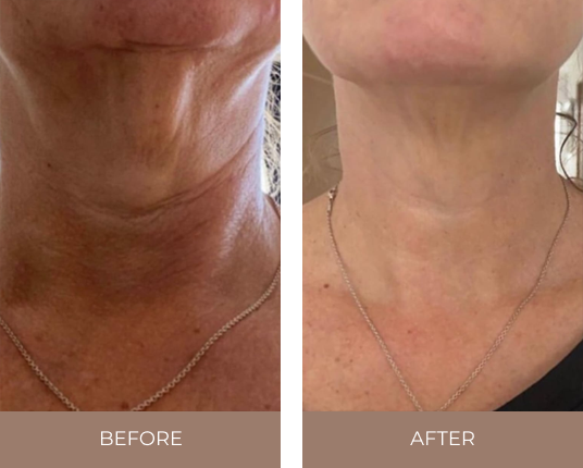 Before and after comparison showing changes in skin appearance