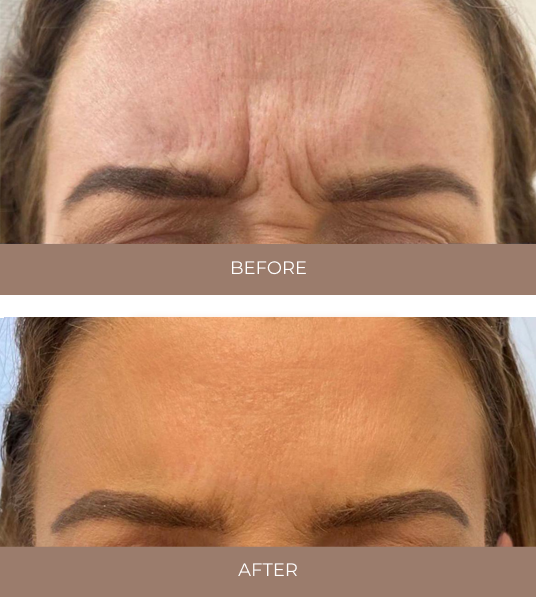 Before and after comparison showing forehead lines