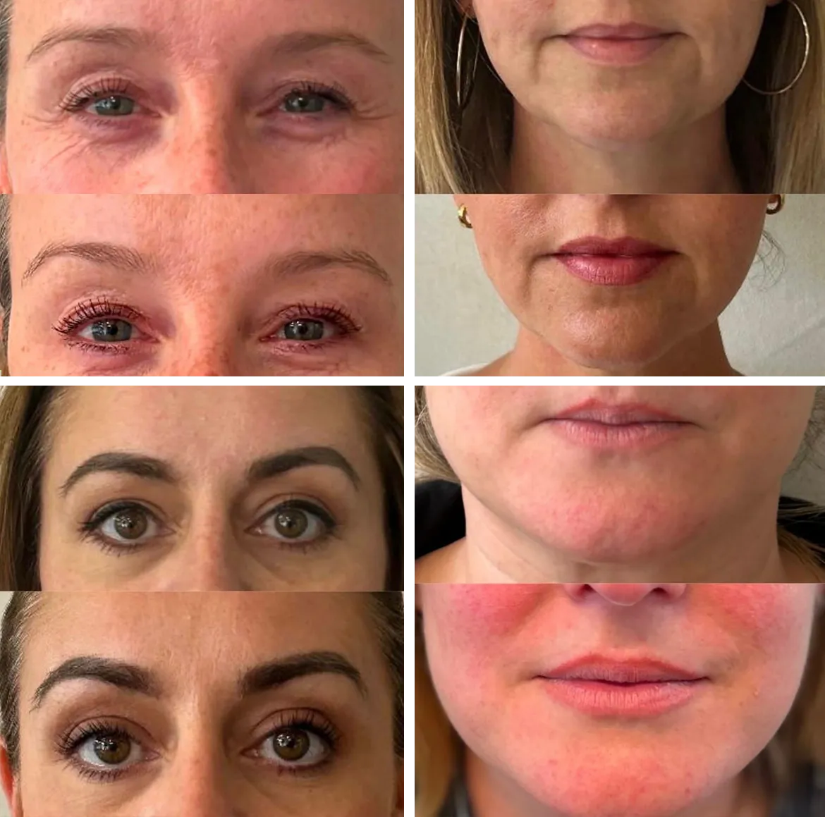 Full-Face Botox Treatment Kent