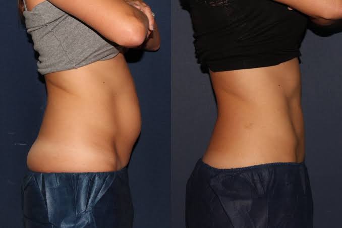 Side view of a client’s waist and abdomen