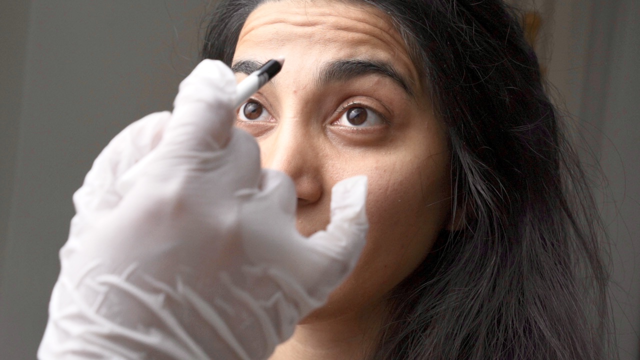 Dr. Blossom marking the forehead during Botox treatment planning