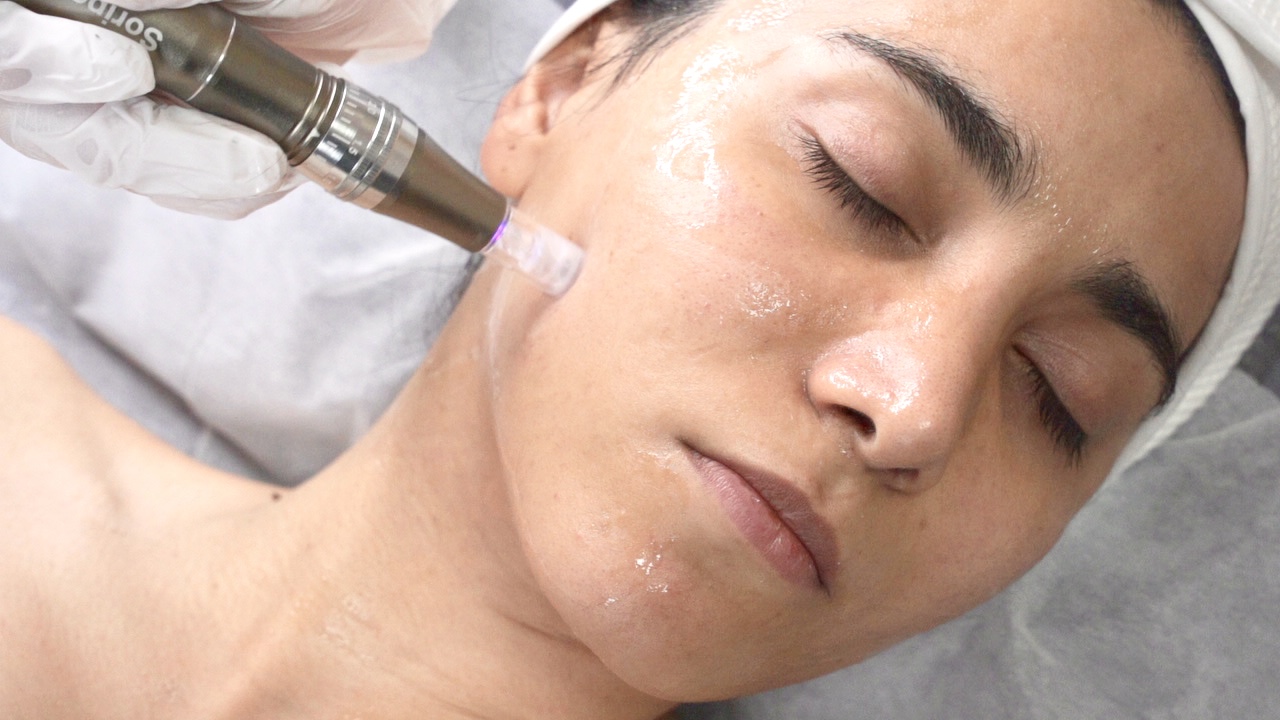 Microneedling treatment at Mahjan SkinCare