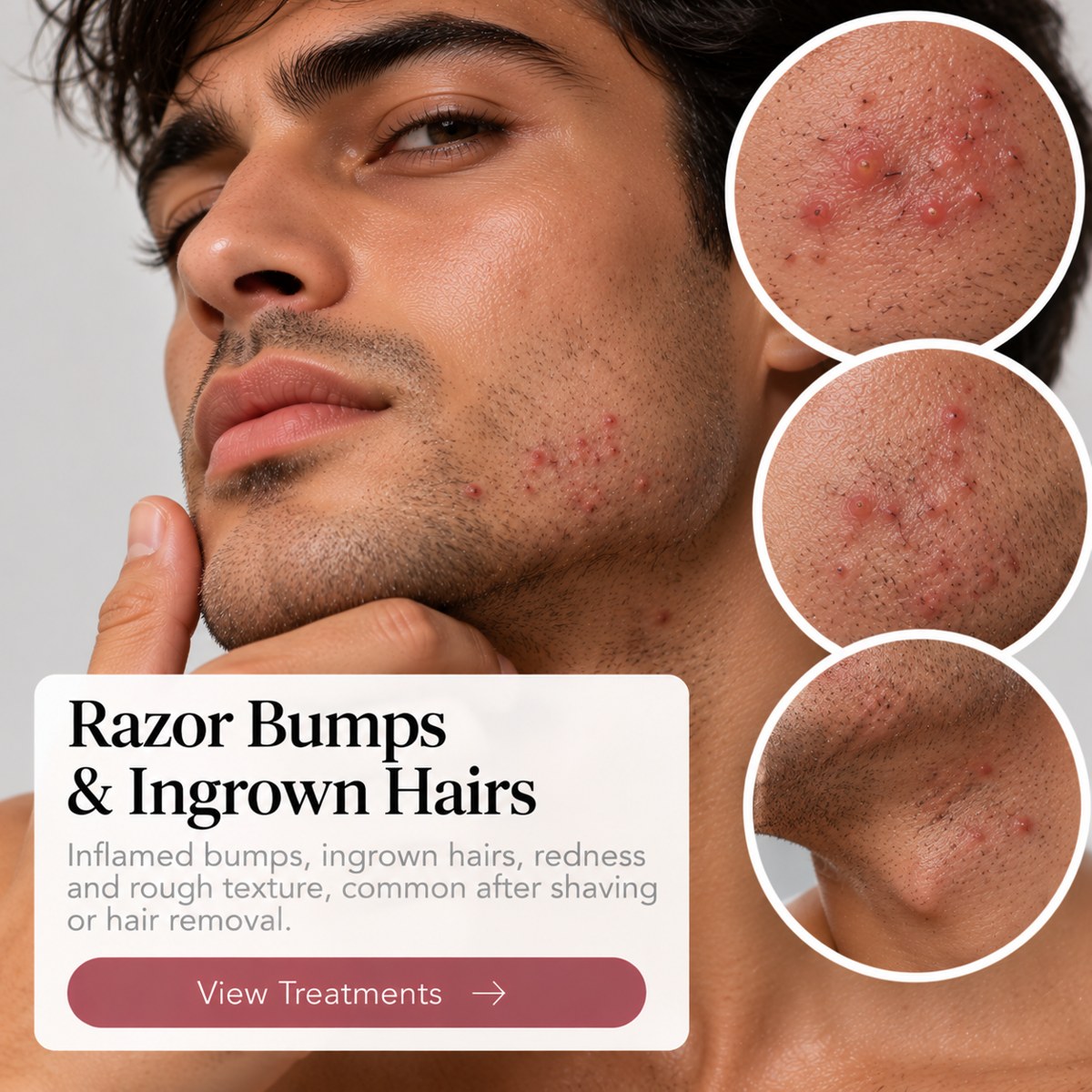 Razor Bumps & Ingrown Hairs