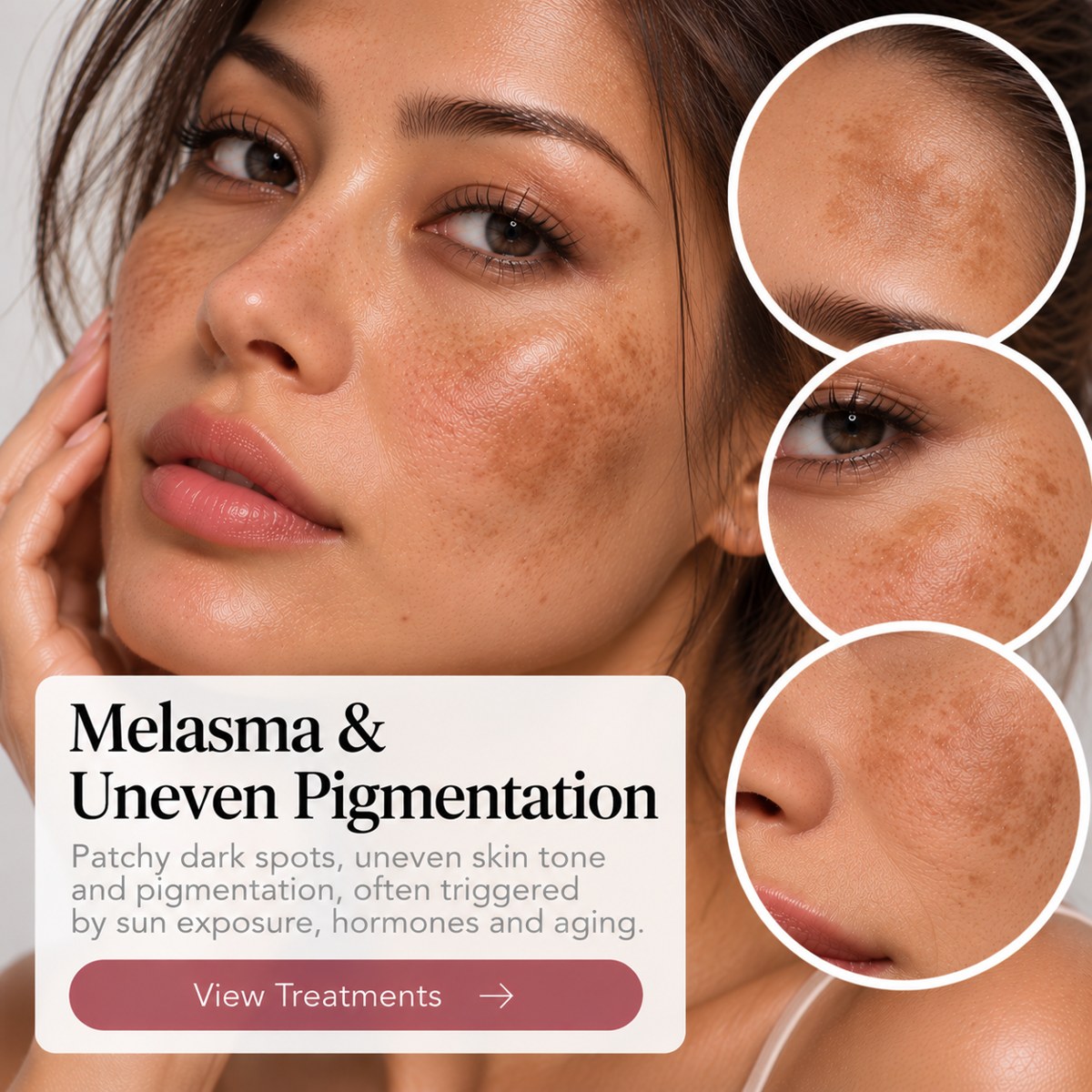 Melasma & Uneven Pigmentation