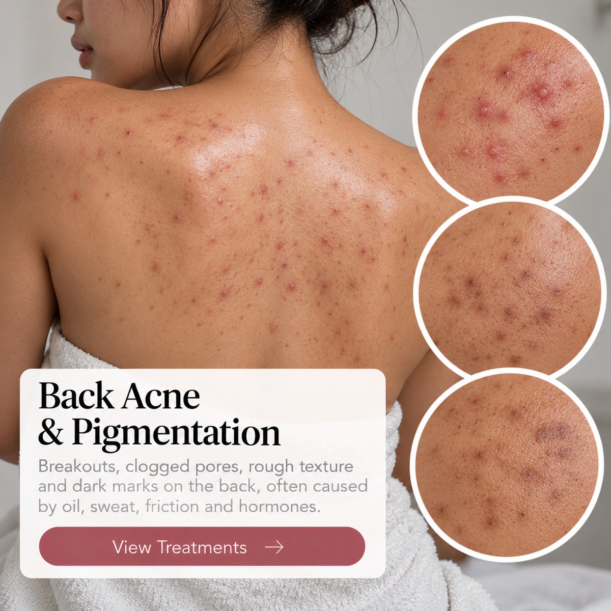 Back Acne & Pigmentation