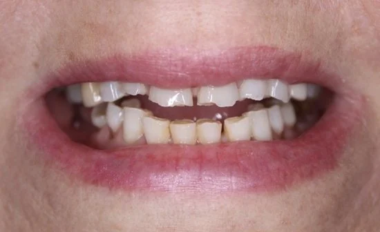 Before a smile makeover