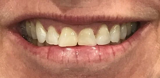 Before porcelain veneers