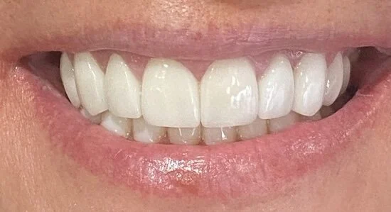 After dental crowns