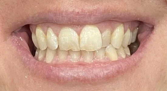 Before dental crowns