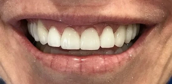 After porcelain veneers
