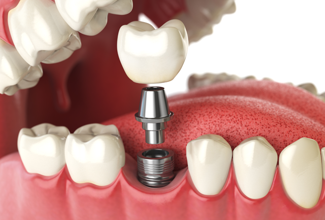 Dental implant model