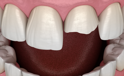 Smile after porcelain veneers