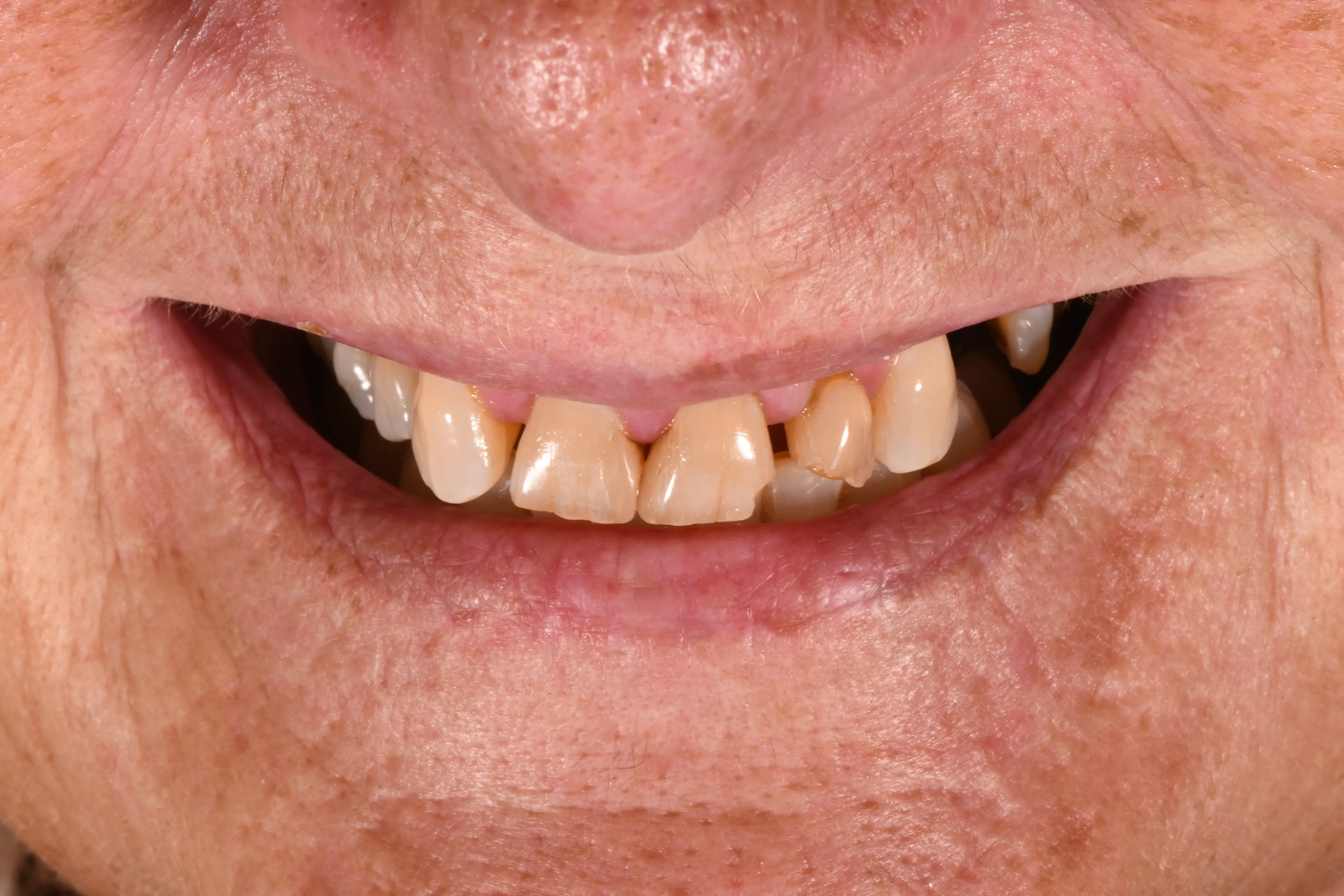 Smile close-up before treatment