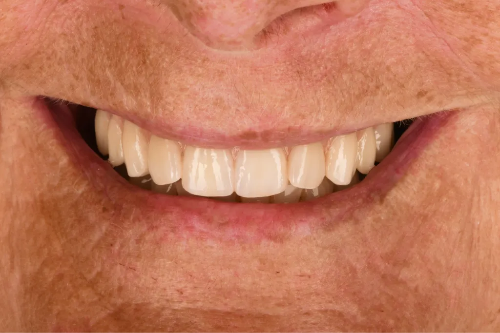 Smile close-up after treatment