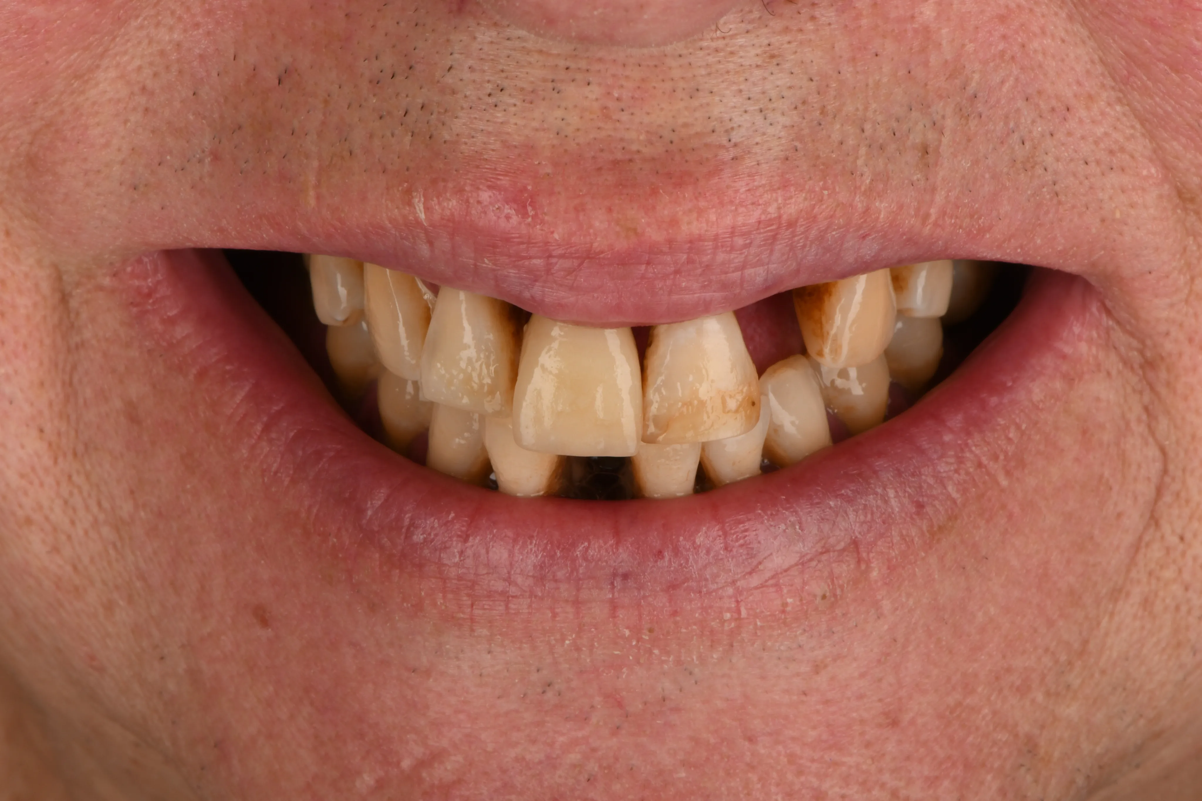 Smile close-up before treatment