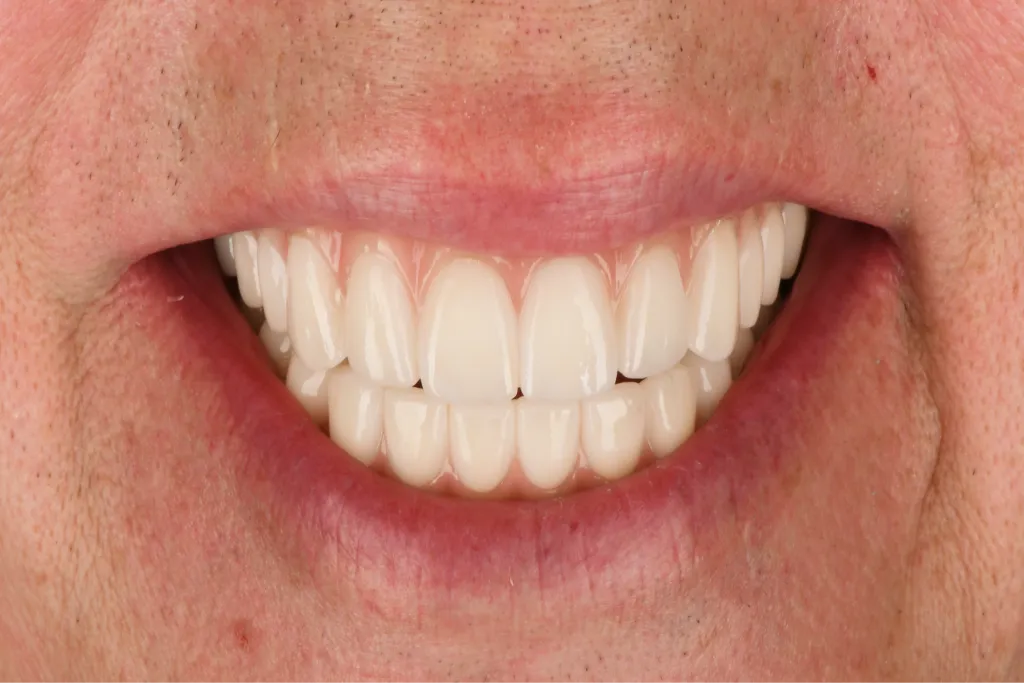 Smile close-up after treatment