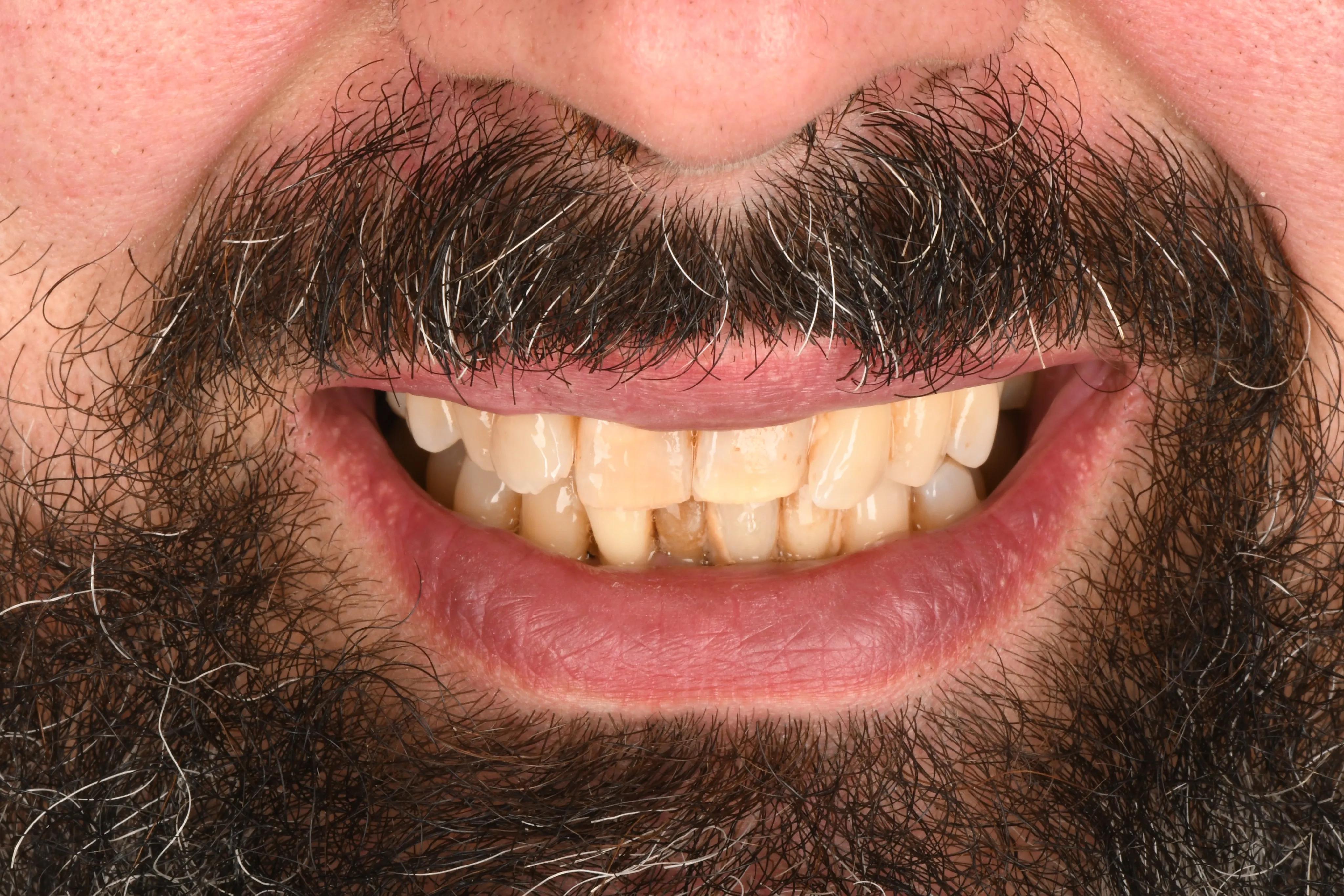 Smile close-up before treatment