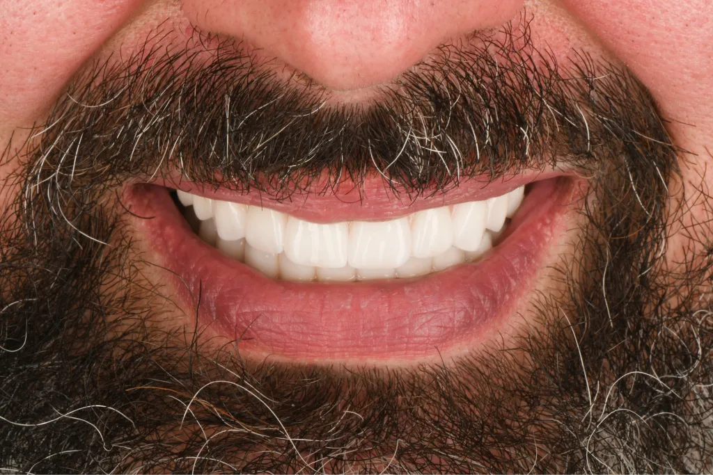 Smile close-up after treatment