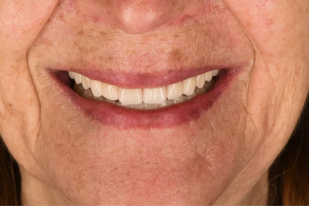 Smile close-up after treatment