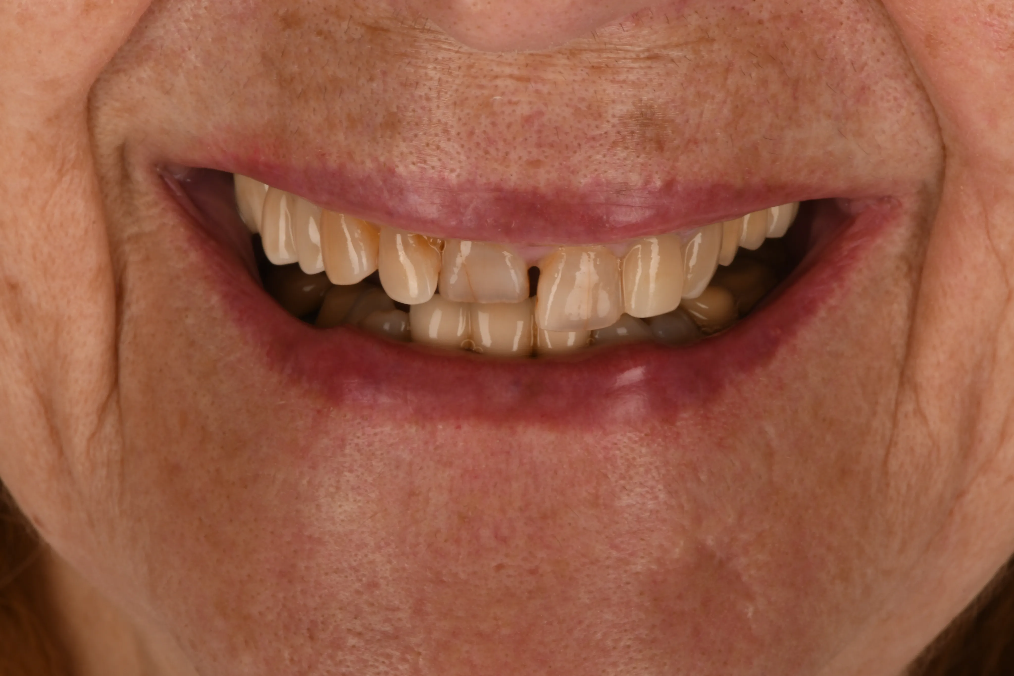 Smile close-up before treatment